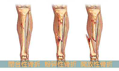 骨科 骨折 骨質疏鬆 腰痛 十字韌帶 椎間盤突出 彈弓手 香港專科中心 骨科